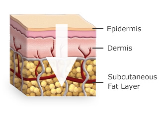 Transdermal Creams - How they work and why - Wellsprings Health